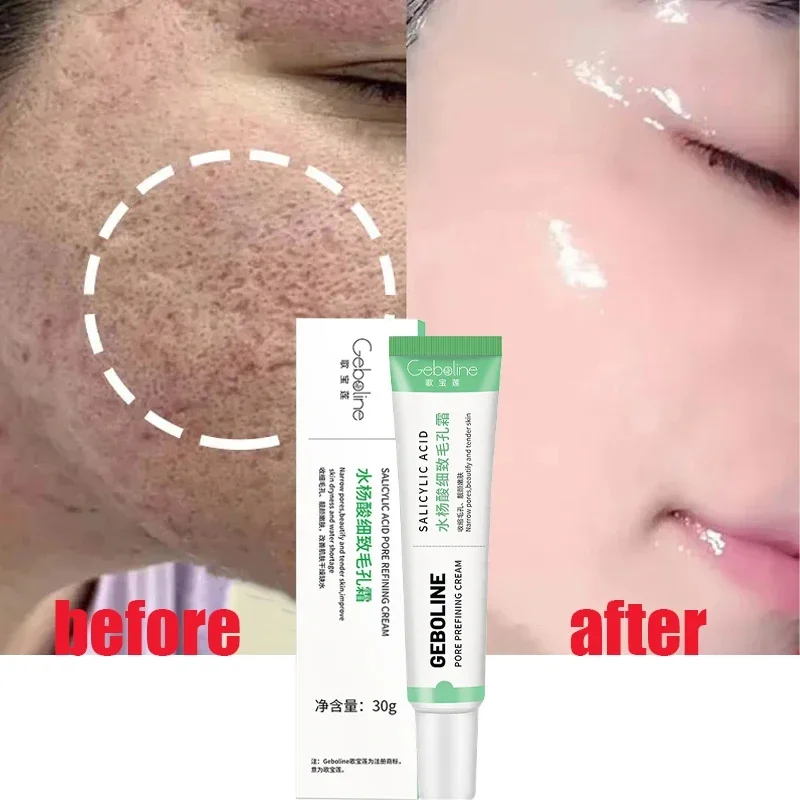 살리실산 모공 수축 크림, 빠른 제거, 큰 모공 제거, - Collagen Peptide Powder 리뷰 및 가격