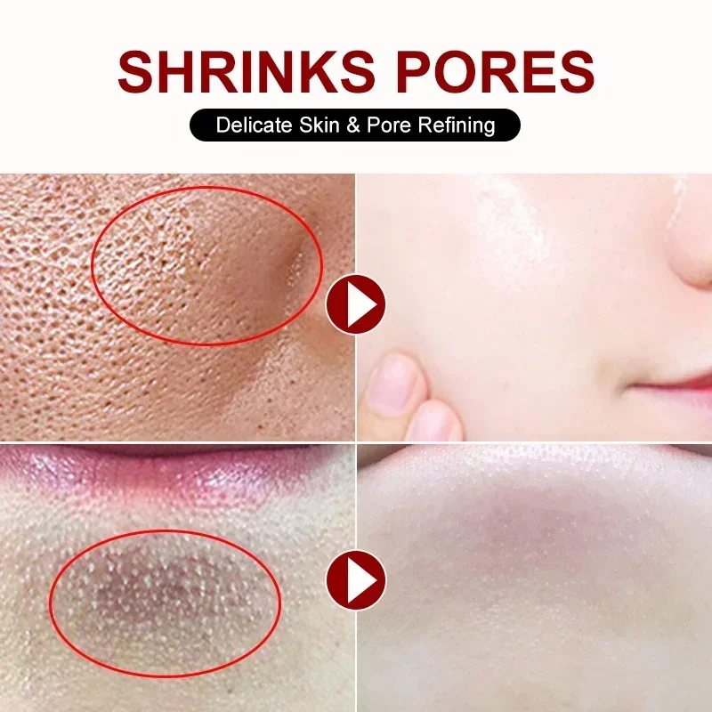 살리실산 모공 수축 크림, 빠른 제거, 큰 모공 제거, - Collagen Peptide Powder 리뷰 및 가격